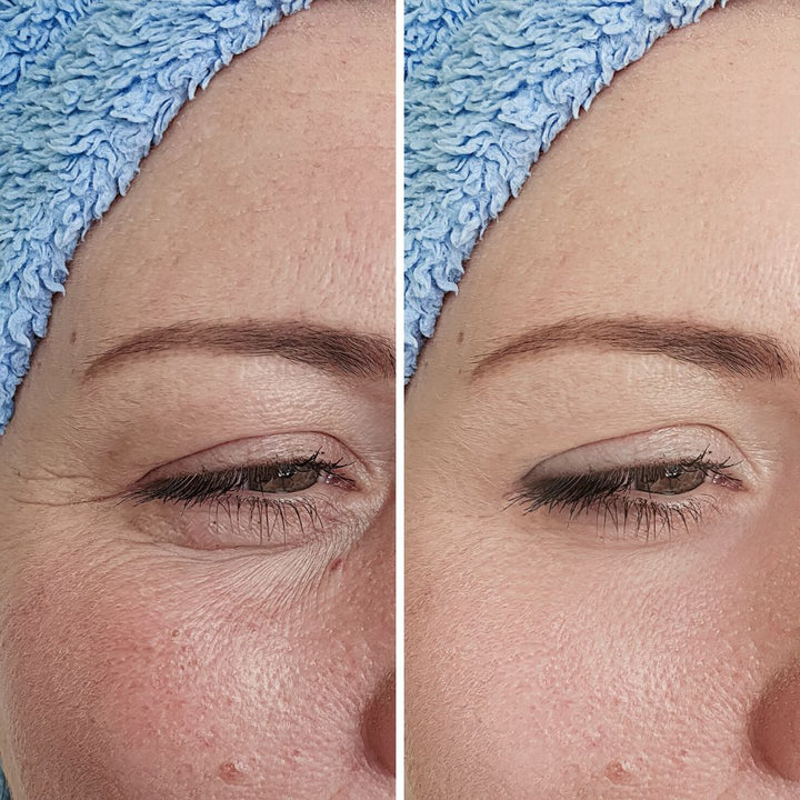 Ultra Meso Portable - Ultrasonido de Alta Intensidad - Antienvejecimiento Cara, Cuello, Papada y Ojos