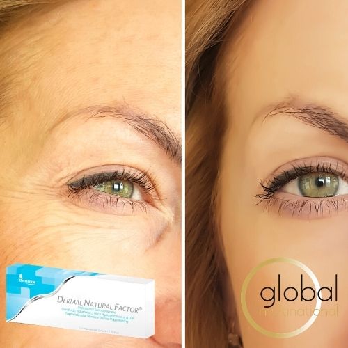 Antes y después de un tratamiento de Dermal Natural Factor, hidratante facial. y antiarrugas.